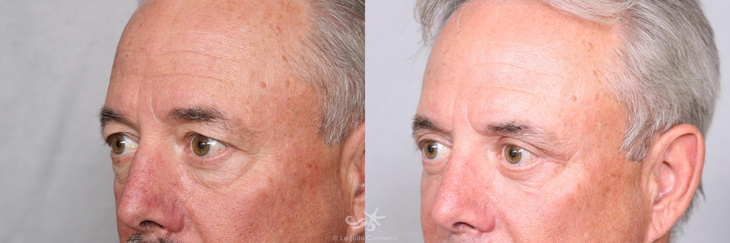 Before & After Eyelid Lift Result 462 Left Oblique View in San Diego, CA