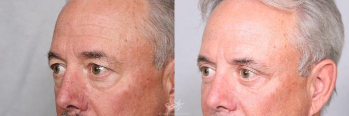 Before & After Eyelid Lift Result 462 Left Oblique View in San Diego, Carlsbad, CA