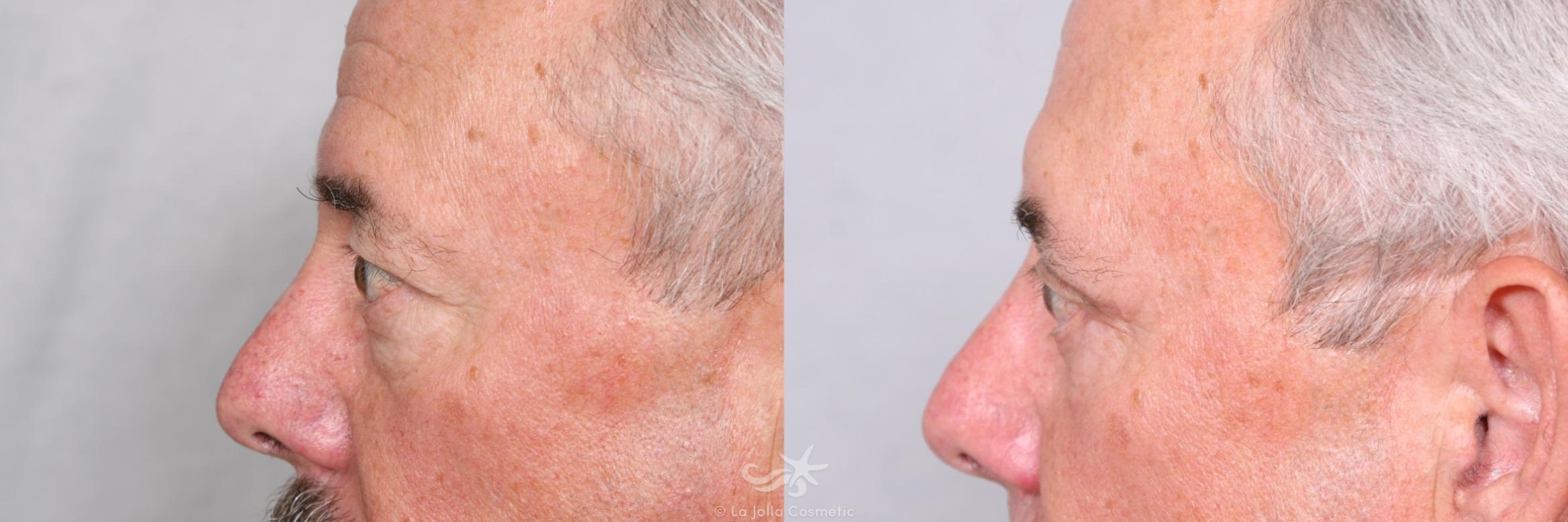 Before & After Eyelid Lift Result 462 Left Side View in San Diego, CA