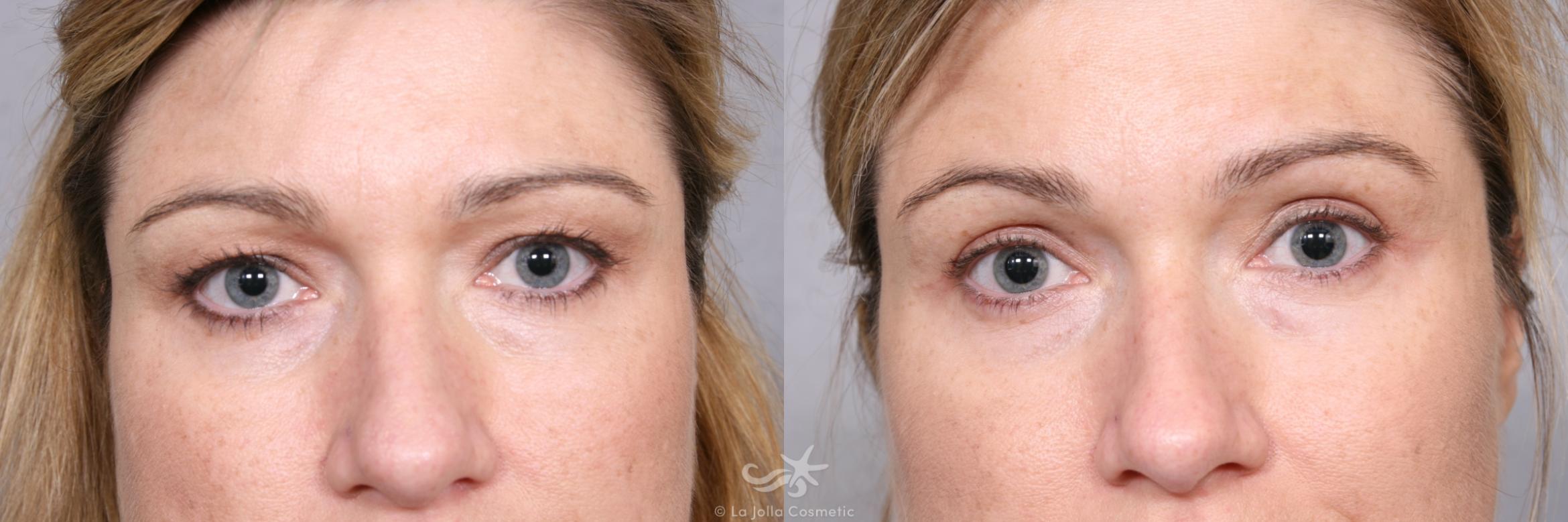 Before & After Eyelid Lift Result 472 Front View in San Diego, CA