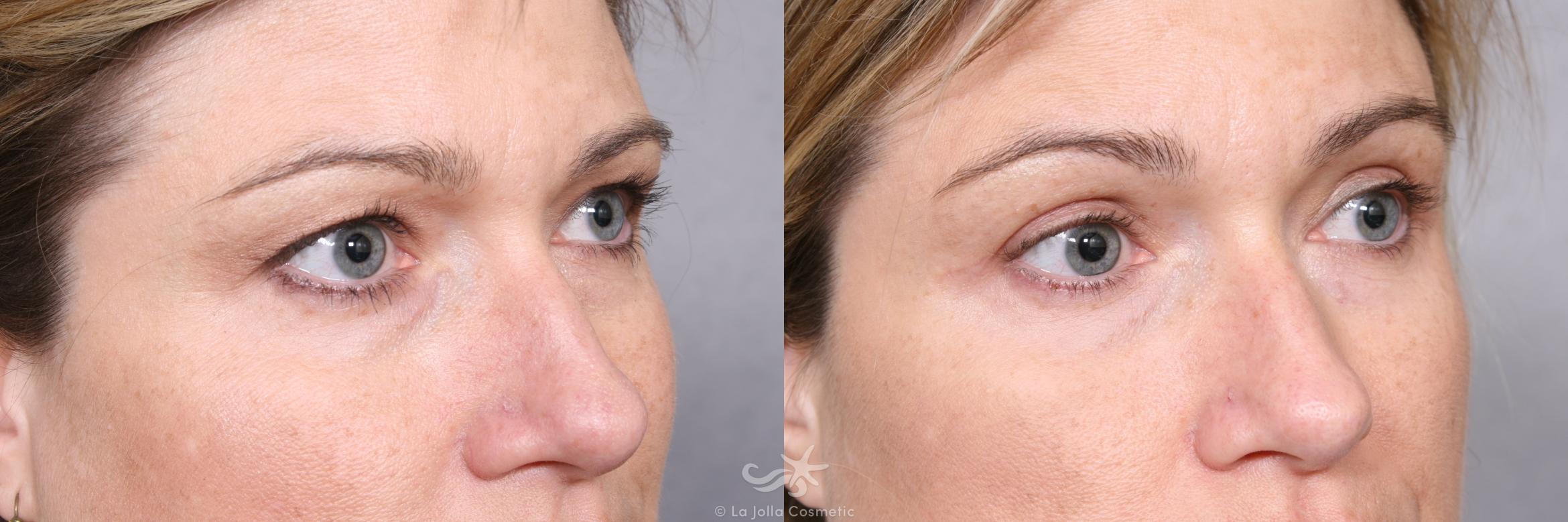 Before & After Eyelid Lift Result 472 Right Oblique View in San Diego, CA
