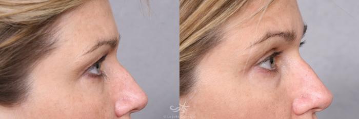 Before & After Eyelid Lift Result 472 Right Side View in San Diego, Carlsbad, CA