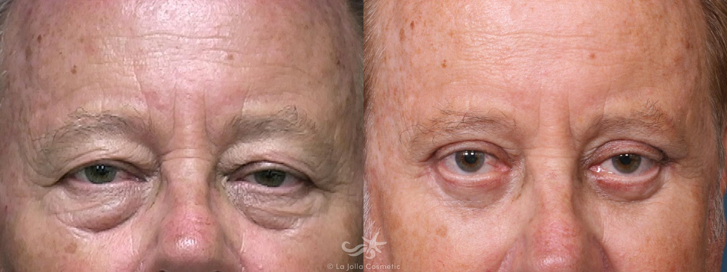 Before & After Eyelid Lift Result 512 Front View in San Diego, CA