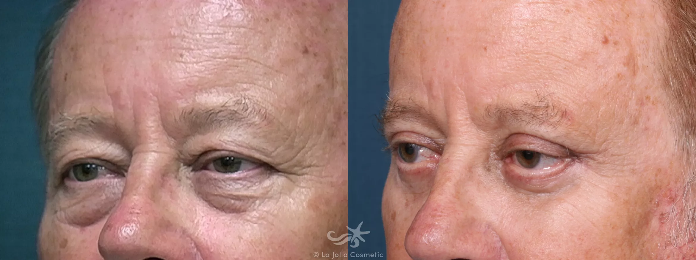 Before & After Eyelid Lift Result 512 Left Oblique View in San Diego, CA