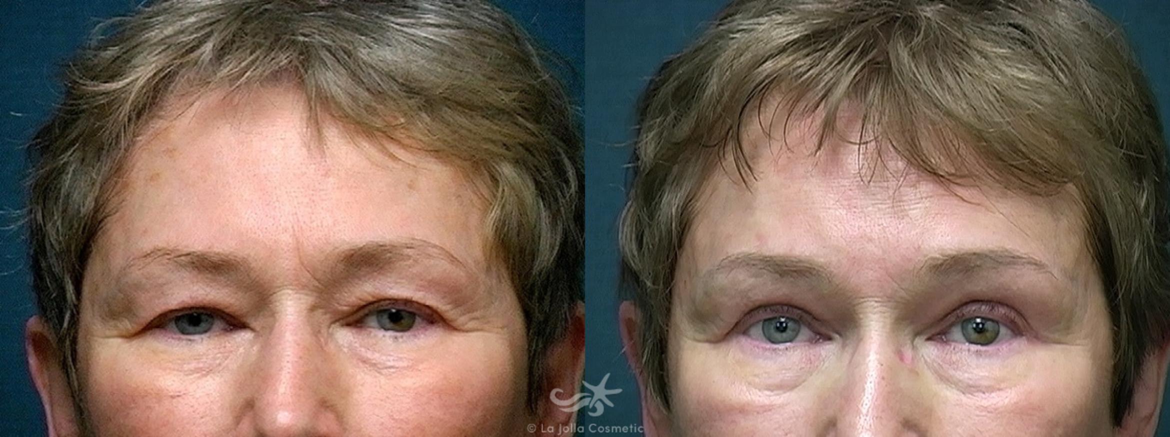 Before & After Eyelid Lift Result 516 Front View in San Diego, CA