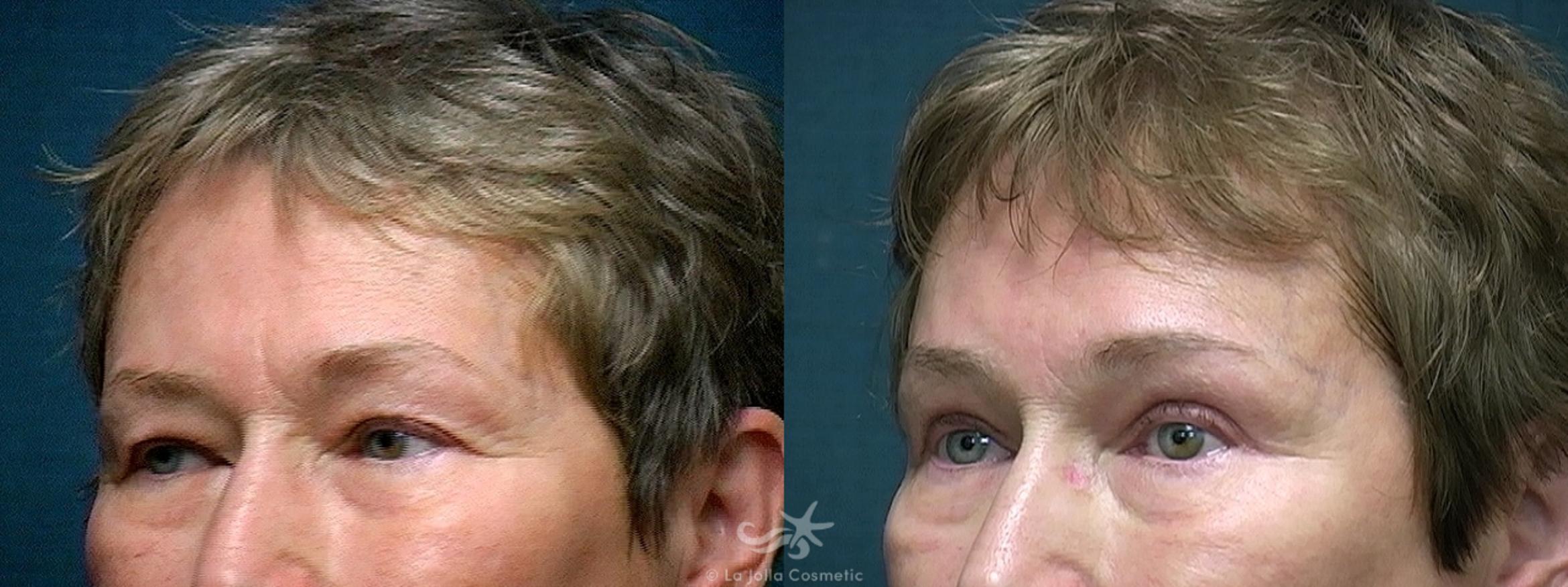 Before & After Eyelid Lift Result 516 Left Oblique View in San Diego, CA