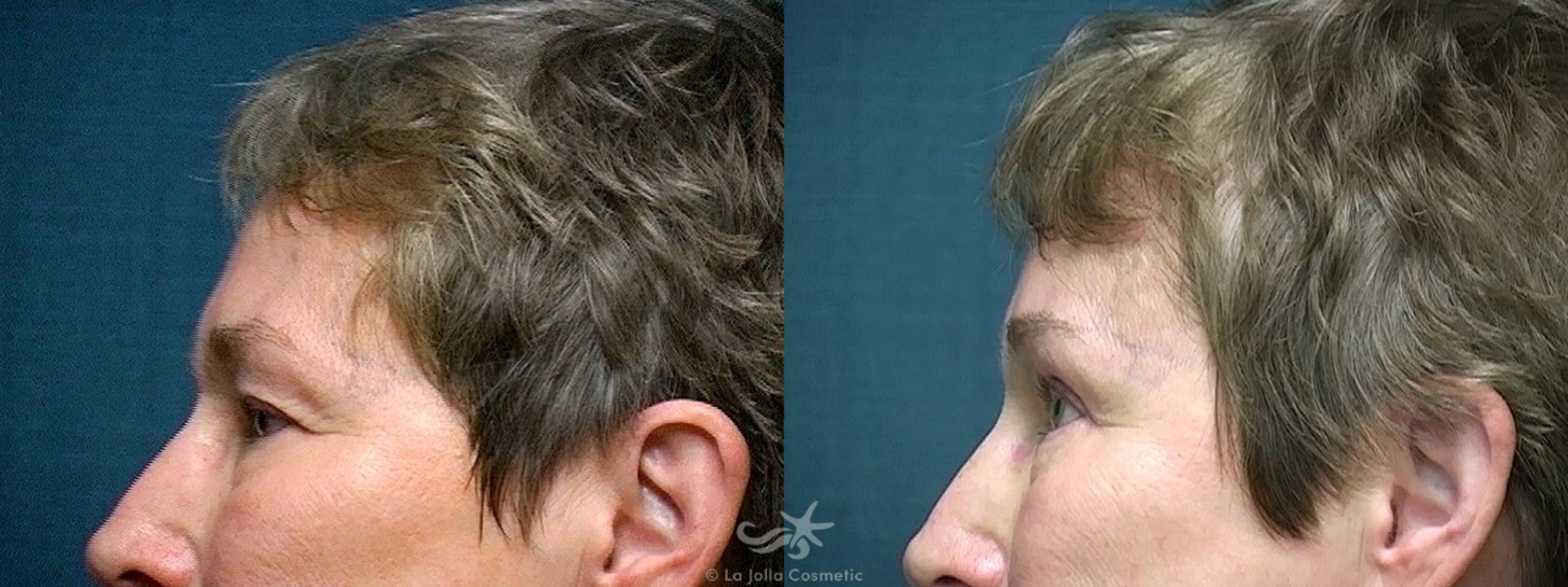 Before & After Eyelid Lift Result 516 Left Side View in San Diego, CA