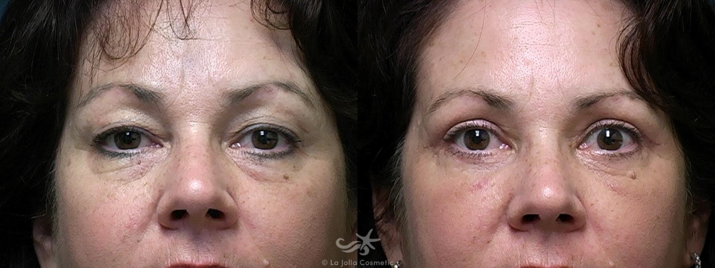 Before & After Eyelid Lift Result 519 Front View in San Diego, CA