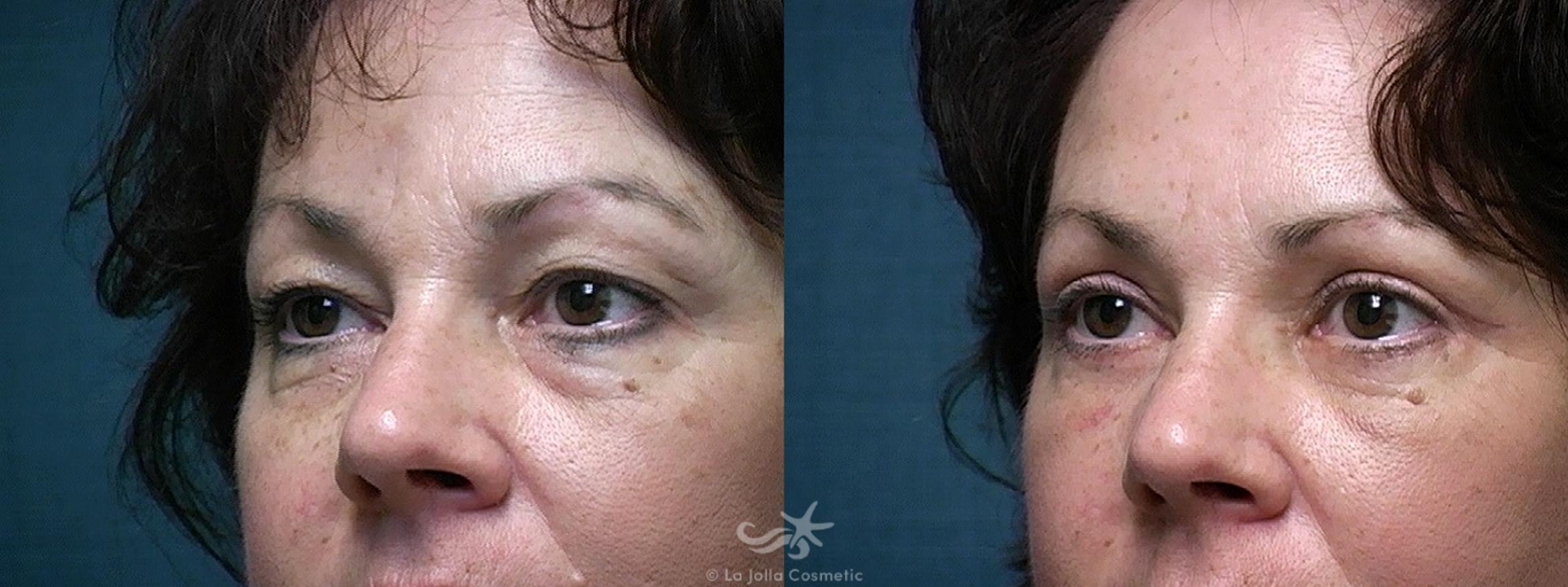 Before & After Eyelid Lift Result 519 Left Oblique View in San Diego, CA