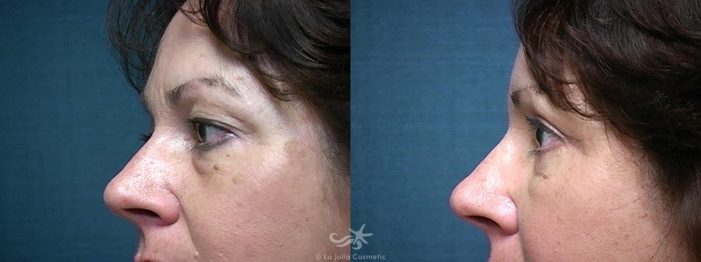 Before & After Eyelid Lift Result 519 Left Side View in San Diego, CA
