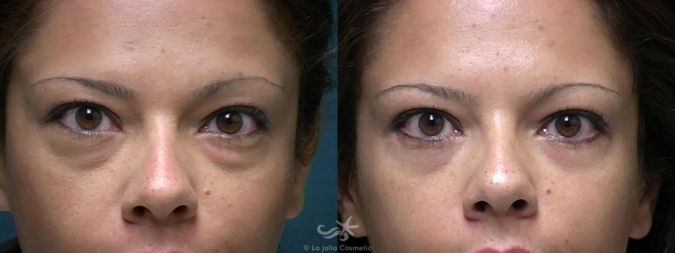 Before & After Eyelid Lift Result 521 Front View in San Diego, CA
