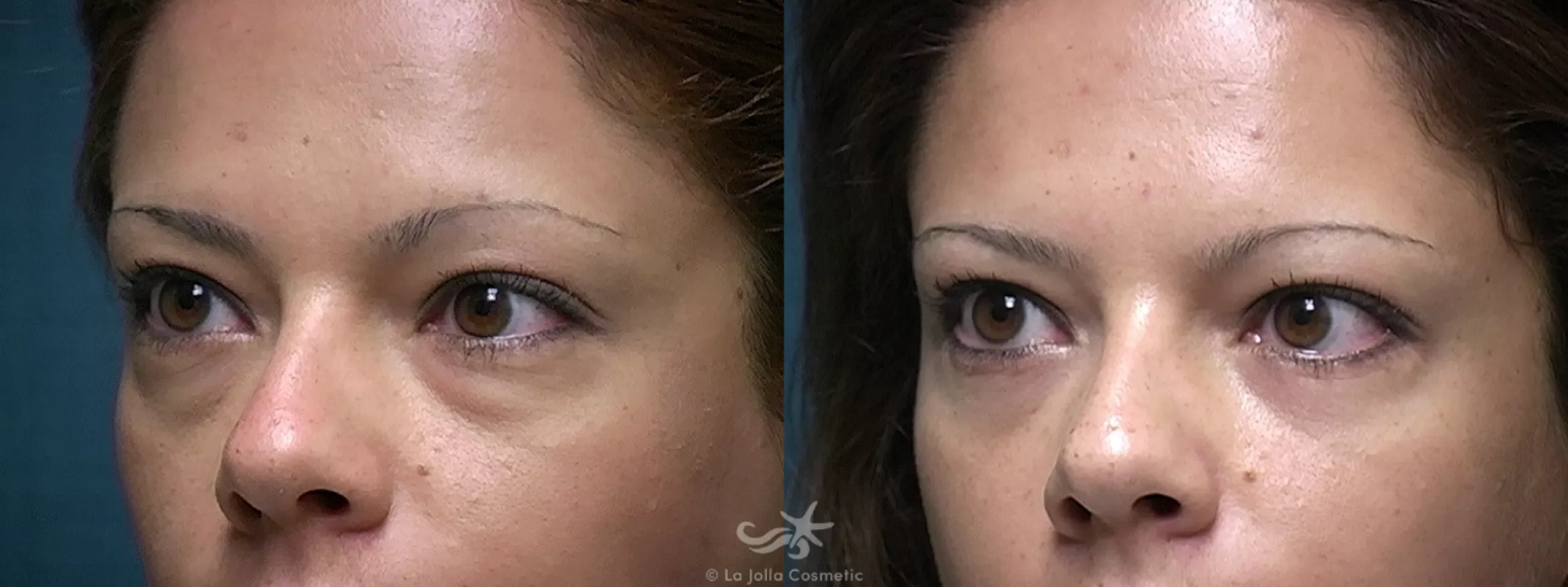 Before & After Eyelid Lift Result 521 Left Oblique View in San Diego, CA