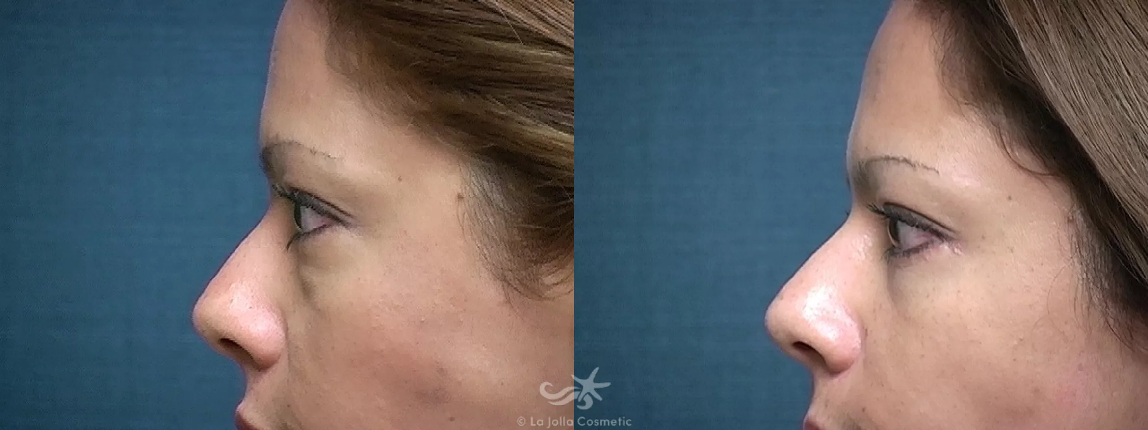 Before & After Eyelid Lift Result 521 Left Side View in San Diego, CA