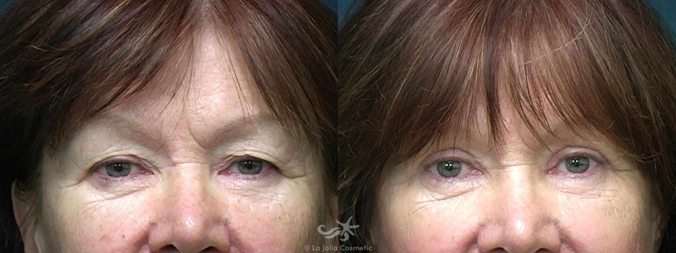 Before & After Eyelid Lift Result 523 Front View in San Diego, CA