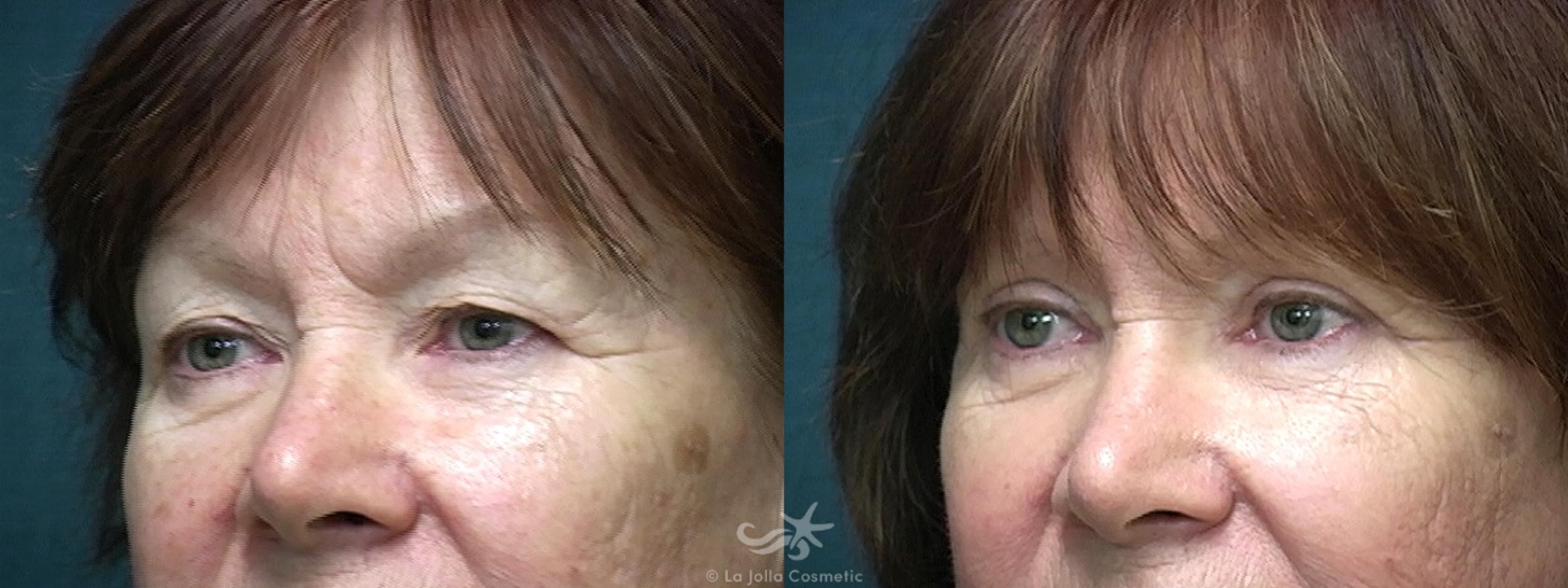 Before & After Eyelid Lift Result 523 Left Oblique View in San Diego, CA