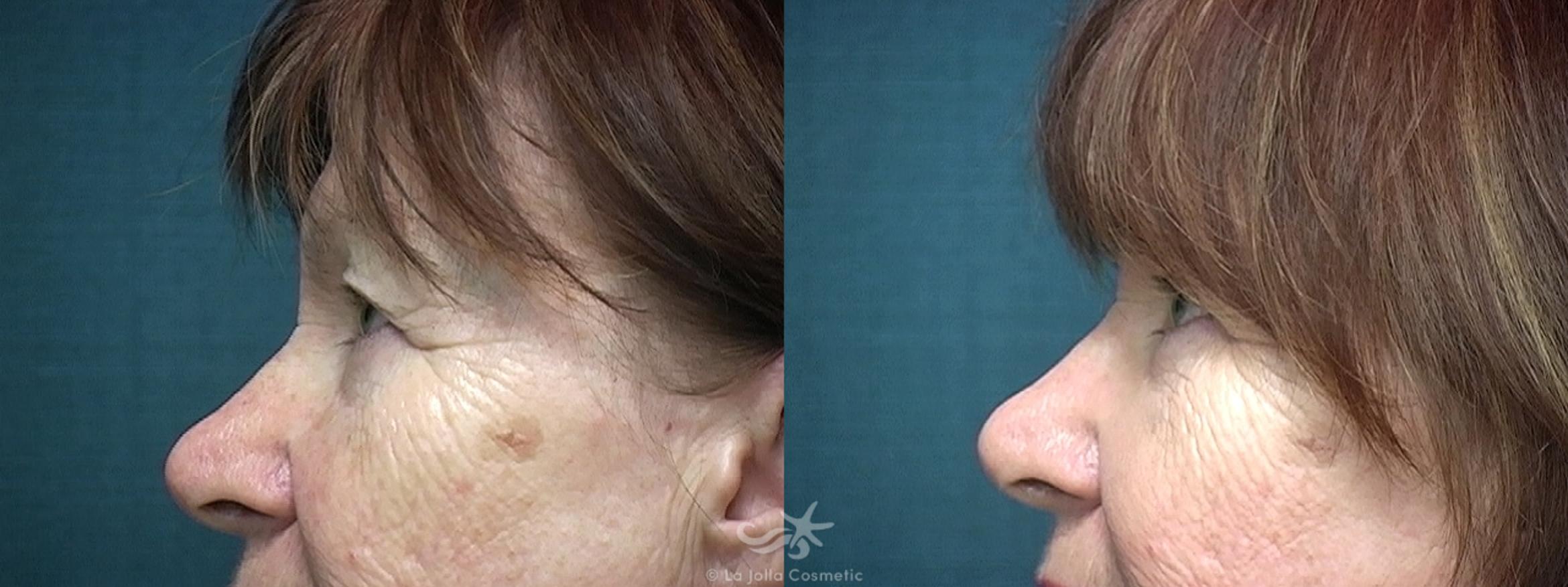 Before & After Eyelid Lift Result 523 Left Side View in San Diego, CA