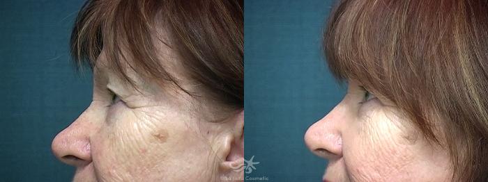 Before & After Eyelid Lift Result 523 Left Side View in San Diego, Carlsbad, CA
