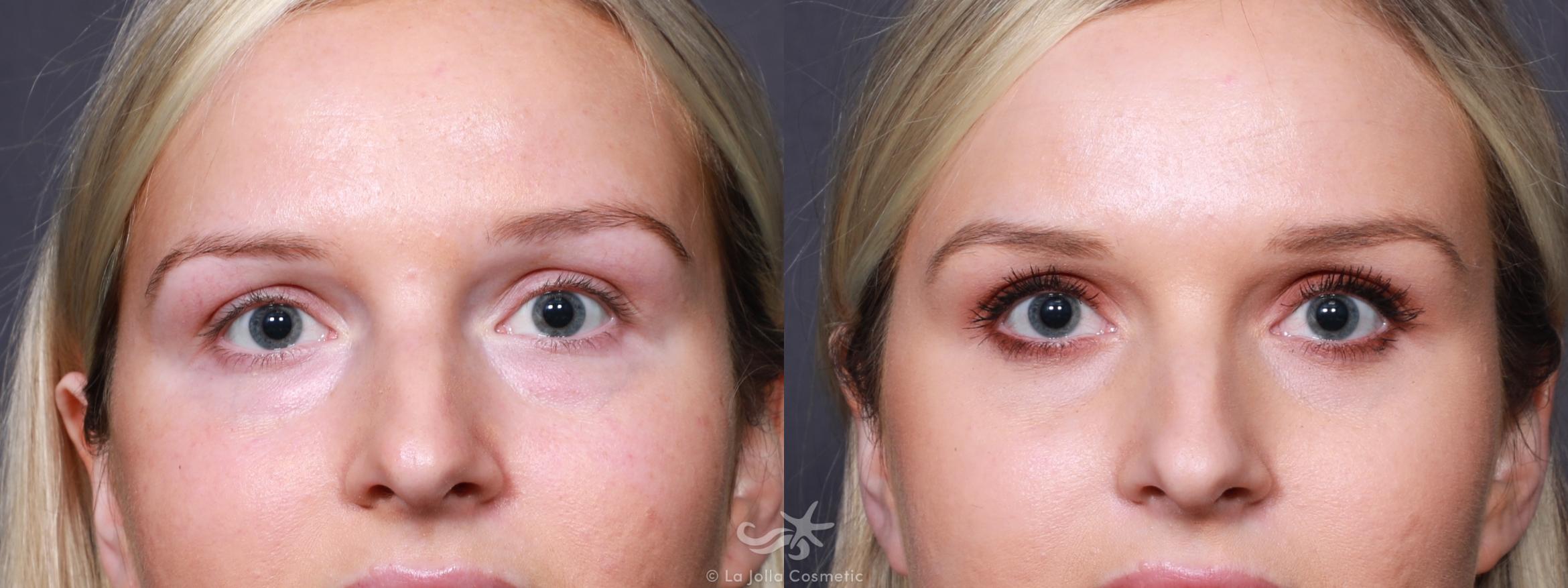 Before & After Eyelid Lift Result 619 Front View in San Diego, CA