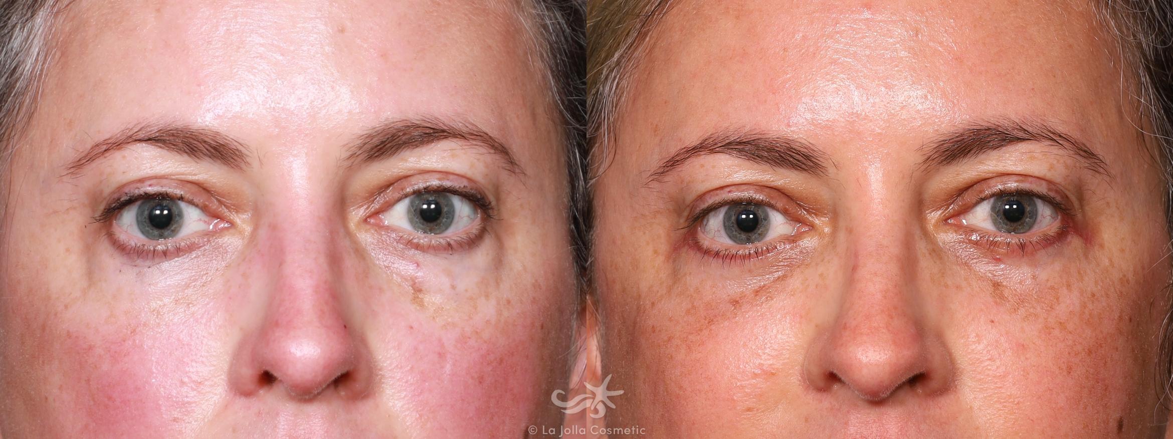 Before & After Eyelid Lift Result 646 Front View in San Diego, CA