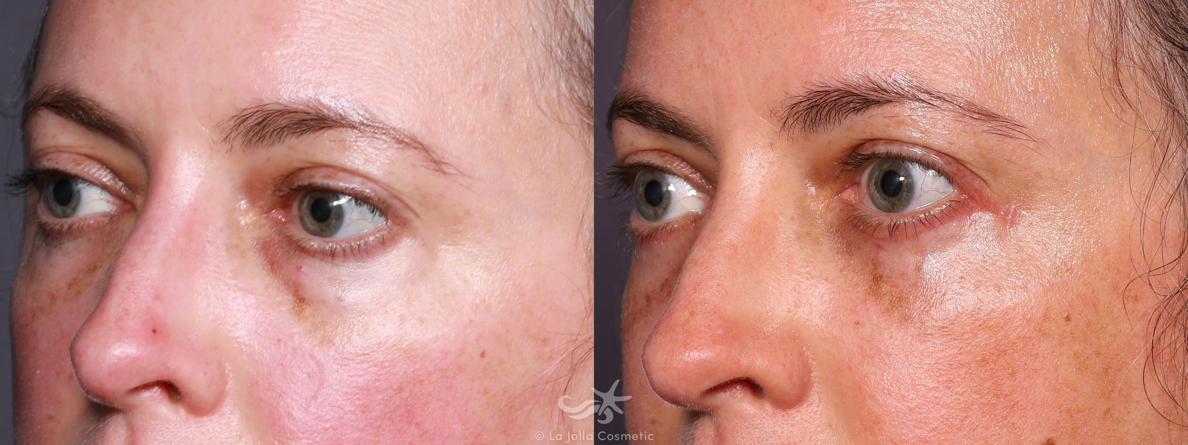 Before & After Eyelid Lift Result 646 Left Oblique View in San Diego, CA