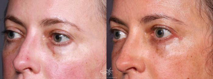 Before & After Eyelid Lift Result 646 Left Oblique View in San Diego, Carlsbad, CA