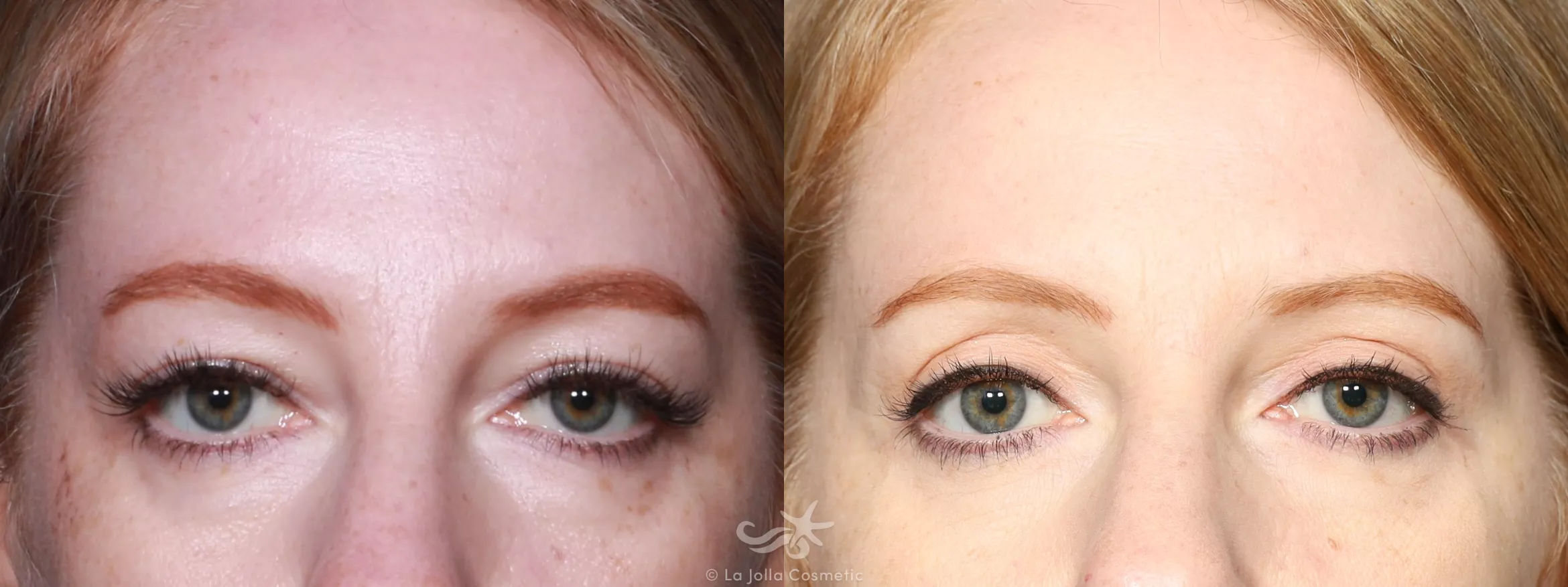 Before & After Eyelid Lift Result 744 Front View in San Diego, CA