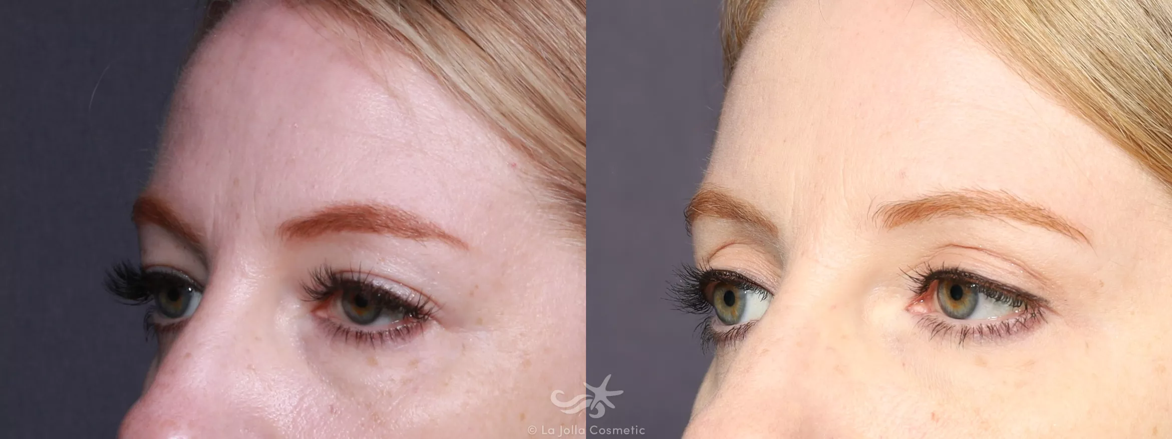 Before & After Eyelid Lift Result 744 Left Oblique View in San Diego, CA