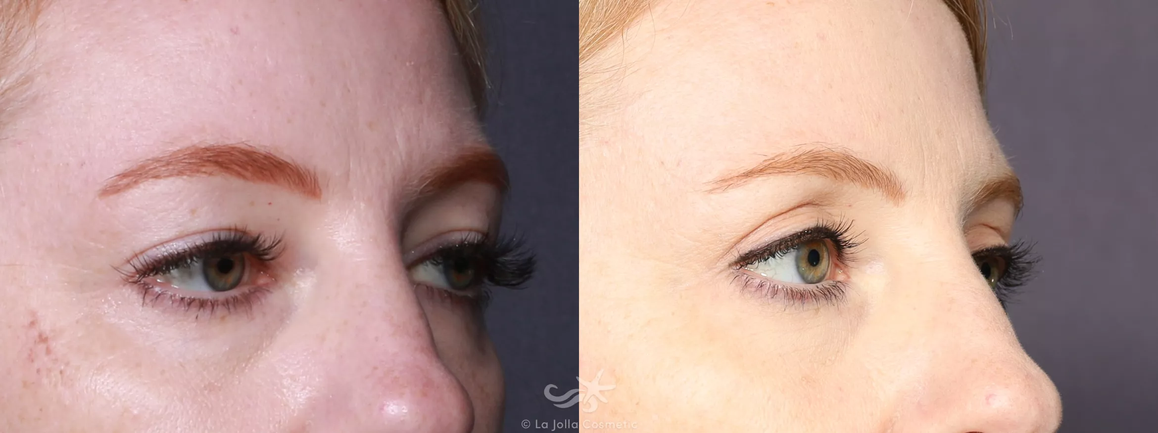 Before & After Eyelid Lift Result 744 Right Oblique View in San Diego, CA