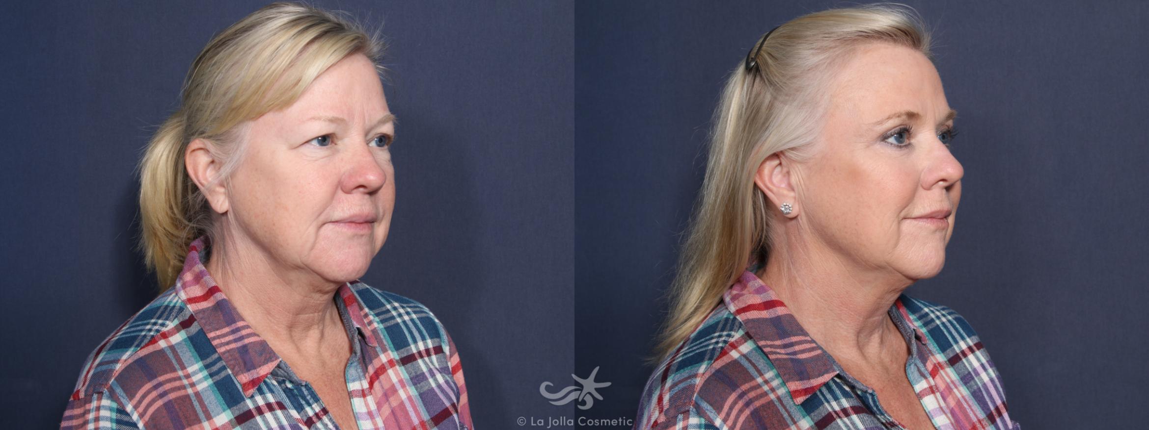 Before & After Eyelid Lift Result 75 Right Oblique View in San Diego, CA