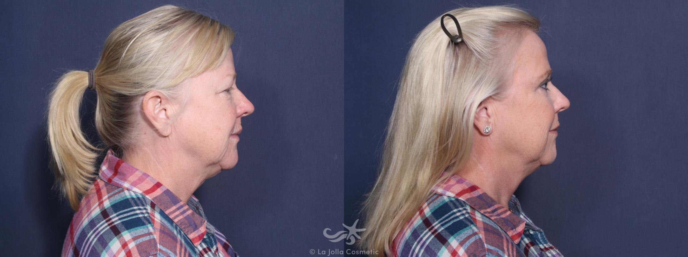 Before & After Eyelid Lift Result 75 Right Side View in San Diego, CA