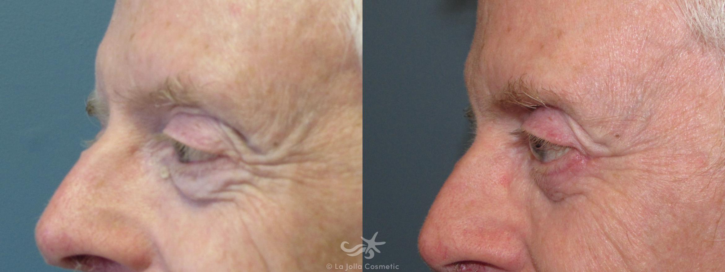 Before & After Eyelid Lift Result 799 Left Side View in San Diego, CA