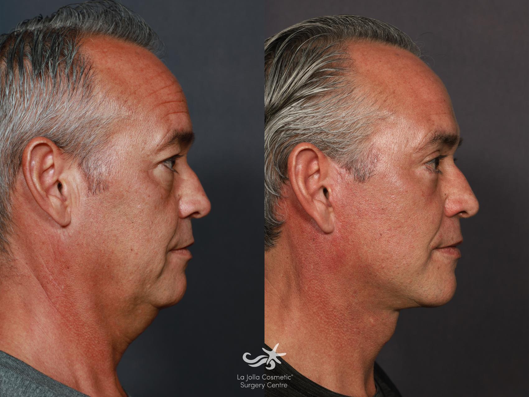 Before & After Eyelid Surgery - Upper Result 713 Right Side View in San Diego, CA