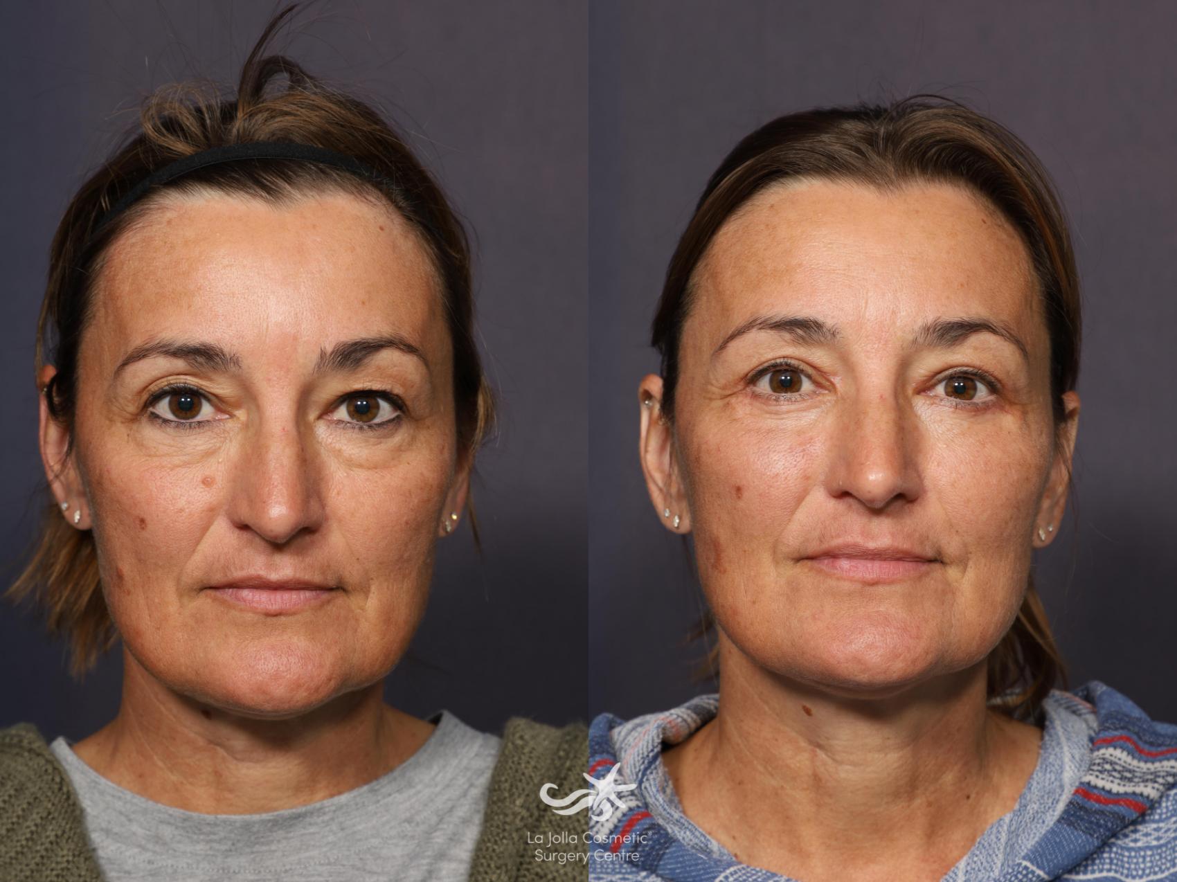 Before & After Eyelid Surgery - Upper Result 945 Front View in San Diego, CA