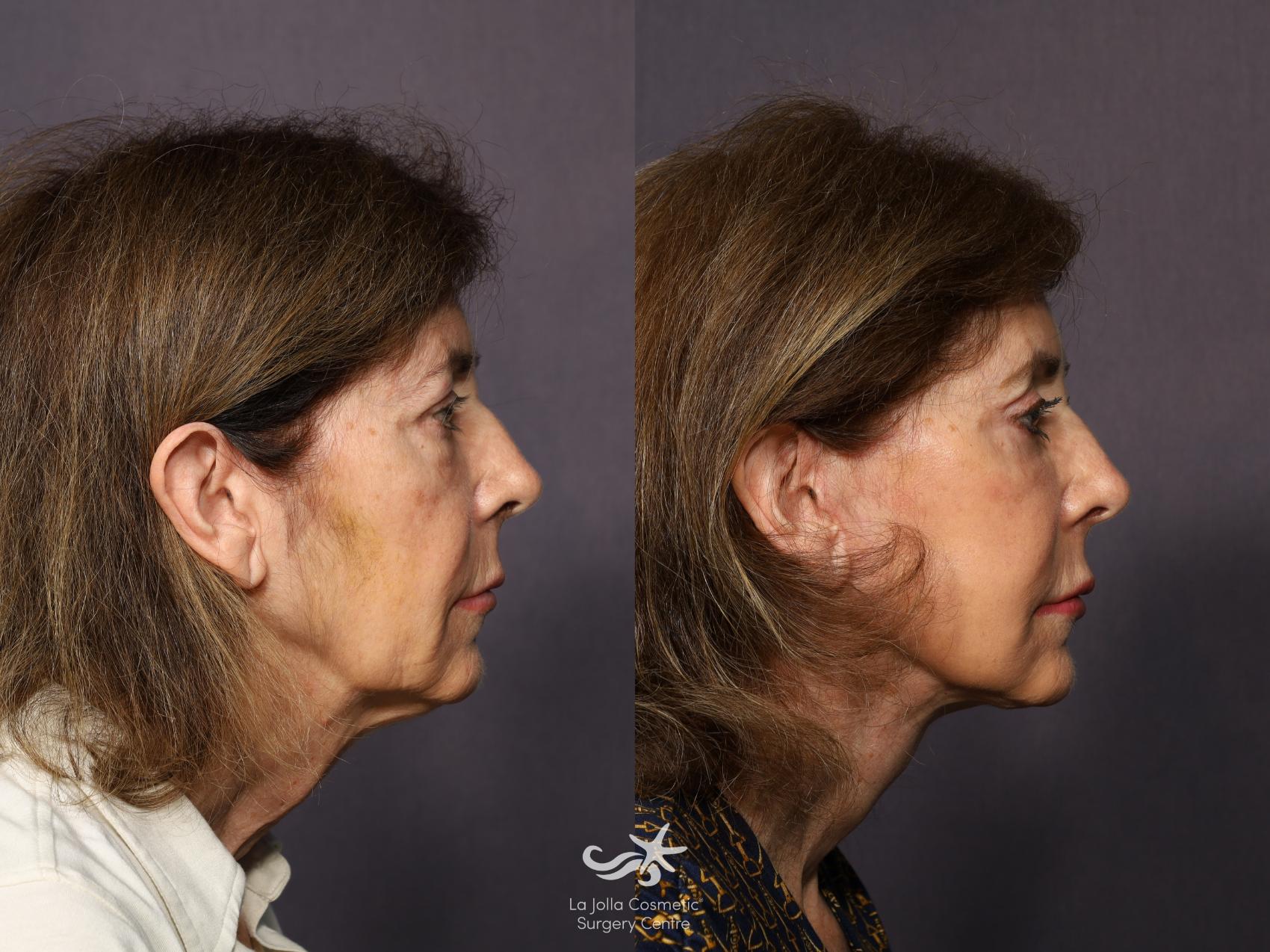Before & After Facelift Result 1090 Right Side View in San Diego, CA