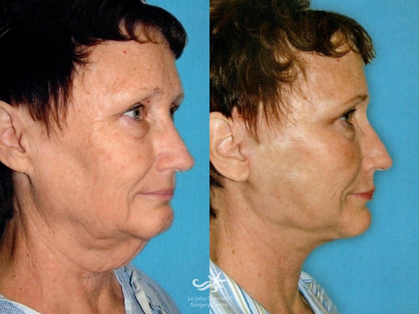 Before & After Facelift Result 1155 Right Oblique View in San Diego, CA