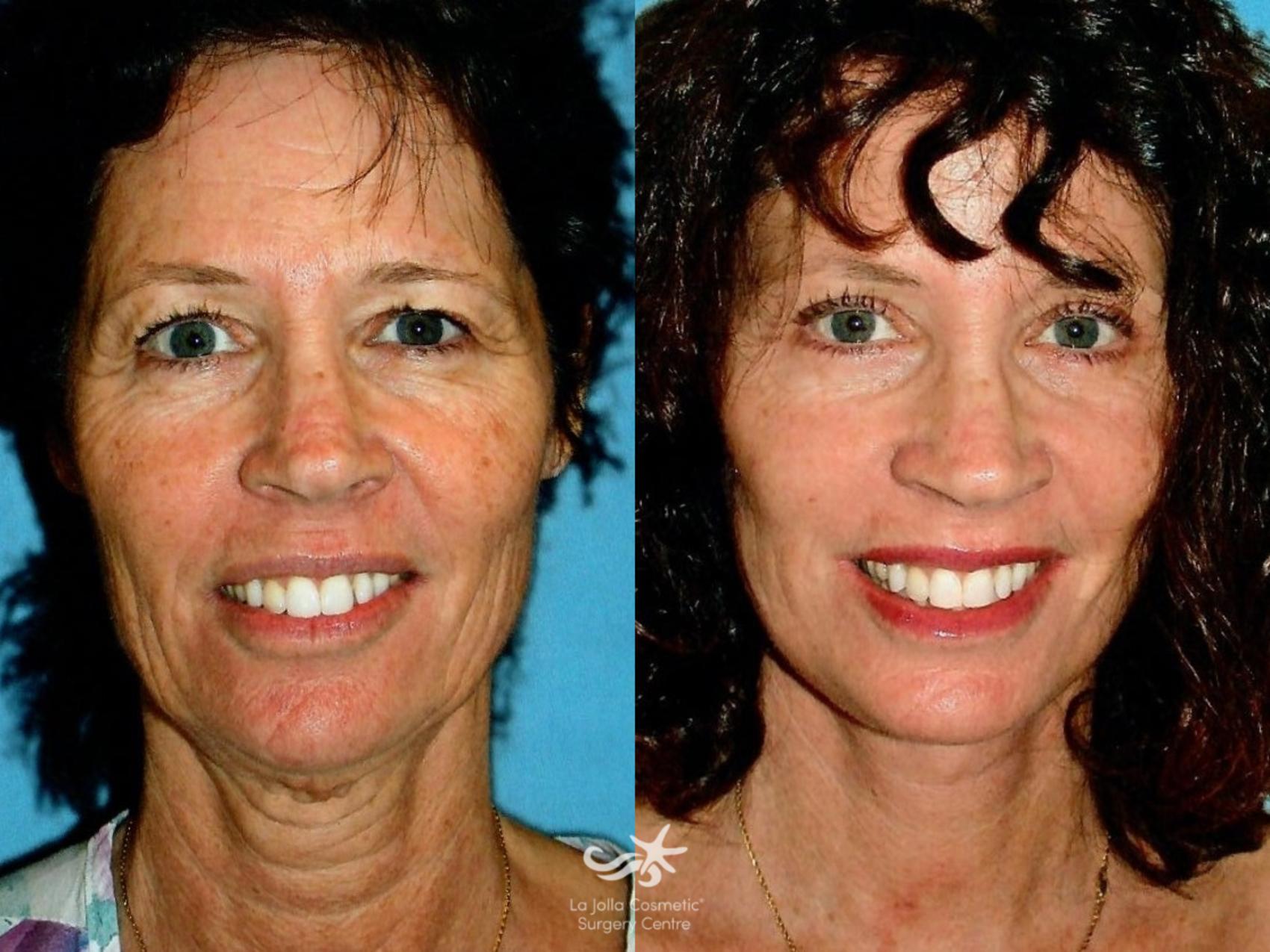 TZ Plasty, Neck Lift & Rejuvenation in San Diego, CA La Jolla