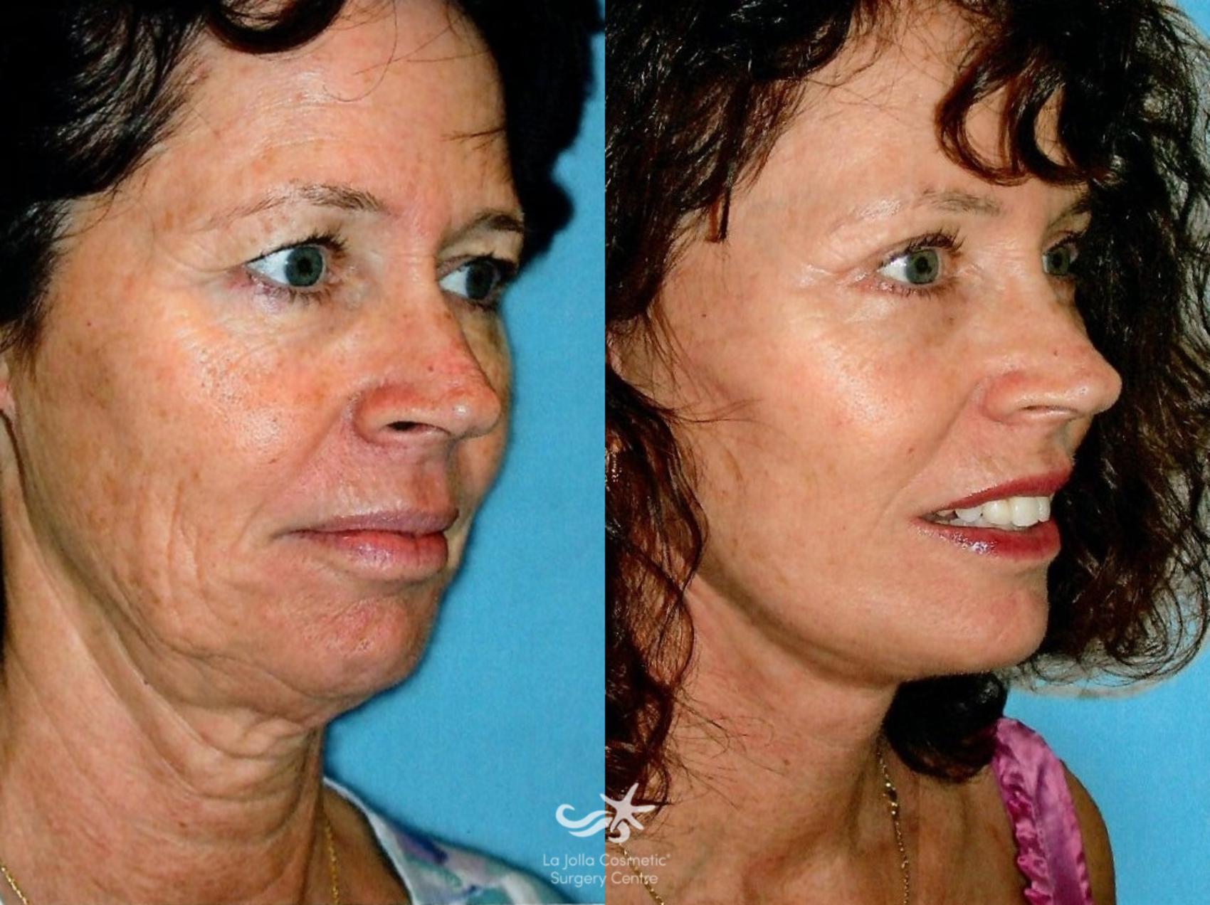 Before & After Facelift Result 1156 Right Oblique View in San Diego, CA