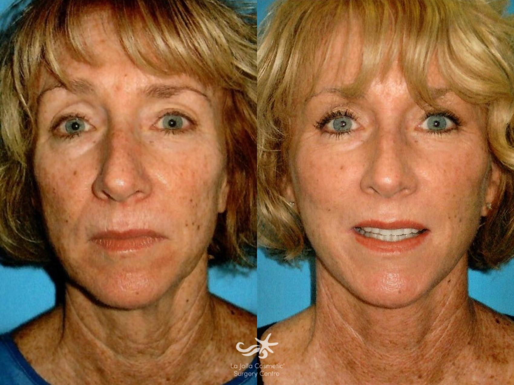 Before & After Facelift Result 1159 Front View in San Diego, CA