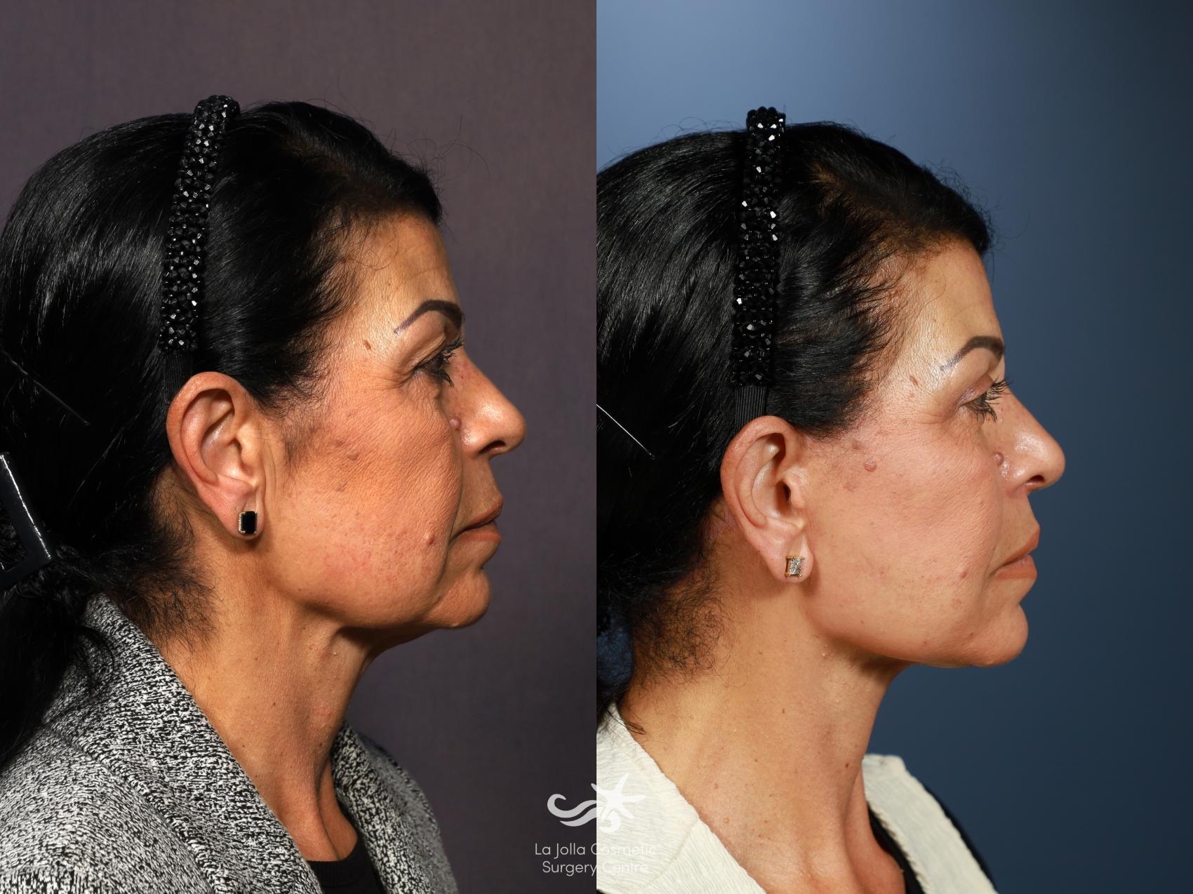 Before & After Facelift Result 1339 Right Side View in San Diego, CA