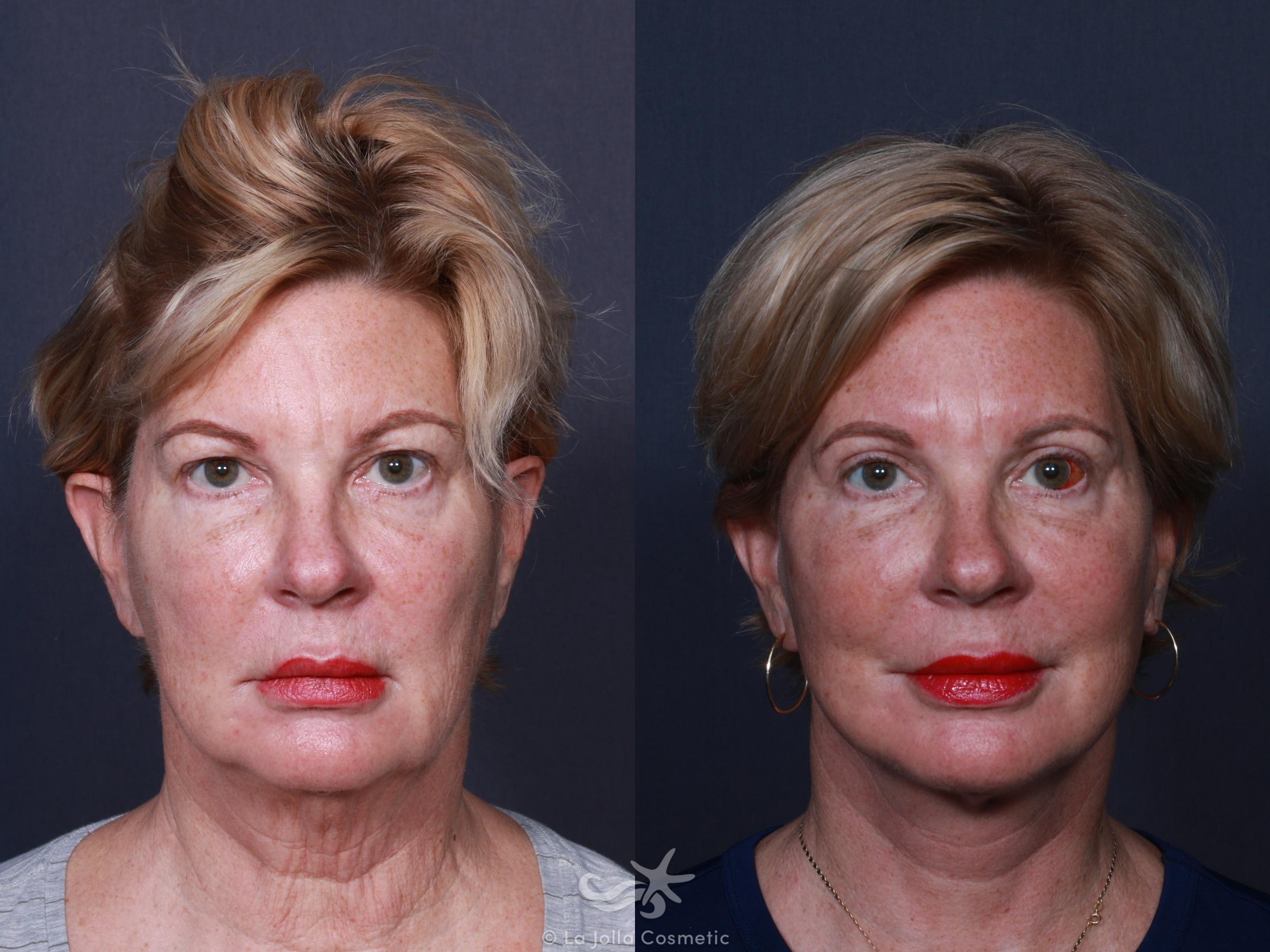 Before & After Facelift Result 2 Front View in San Diego, CA