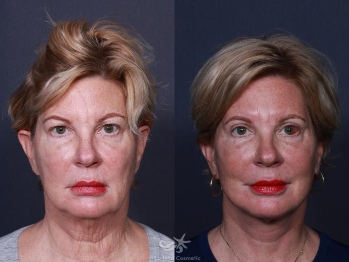 Before & After Facelift Result 2 Front View in San Diego, Carlsbad, CA