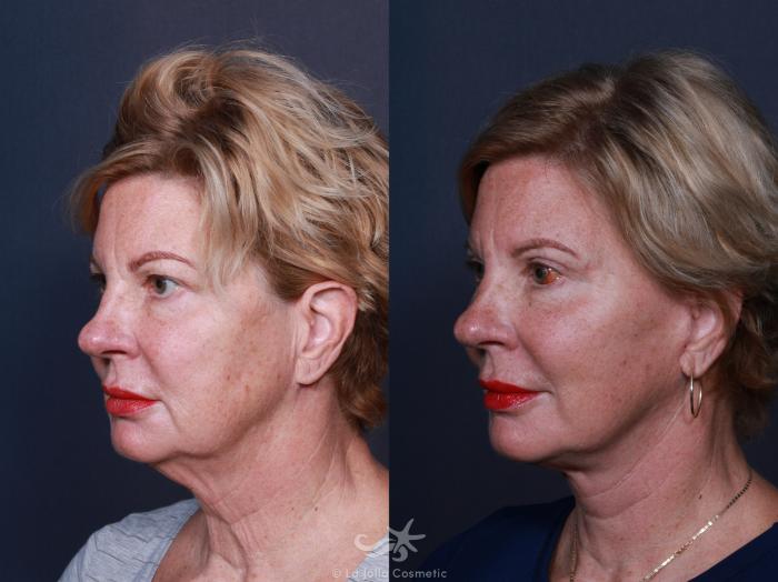 Before & After Facelift Result 2 Left Side View in San Diego, Carlsbad, CA