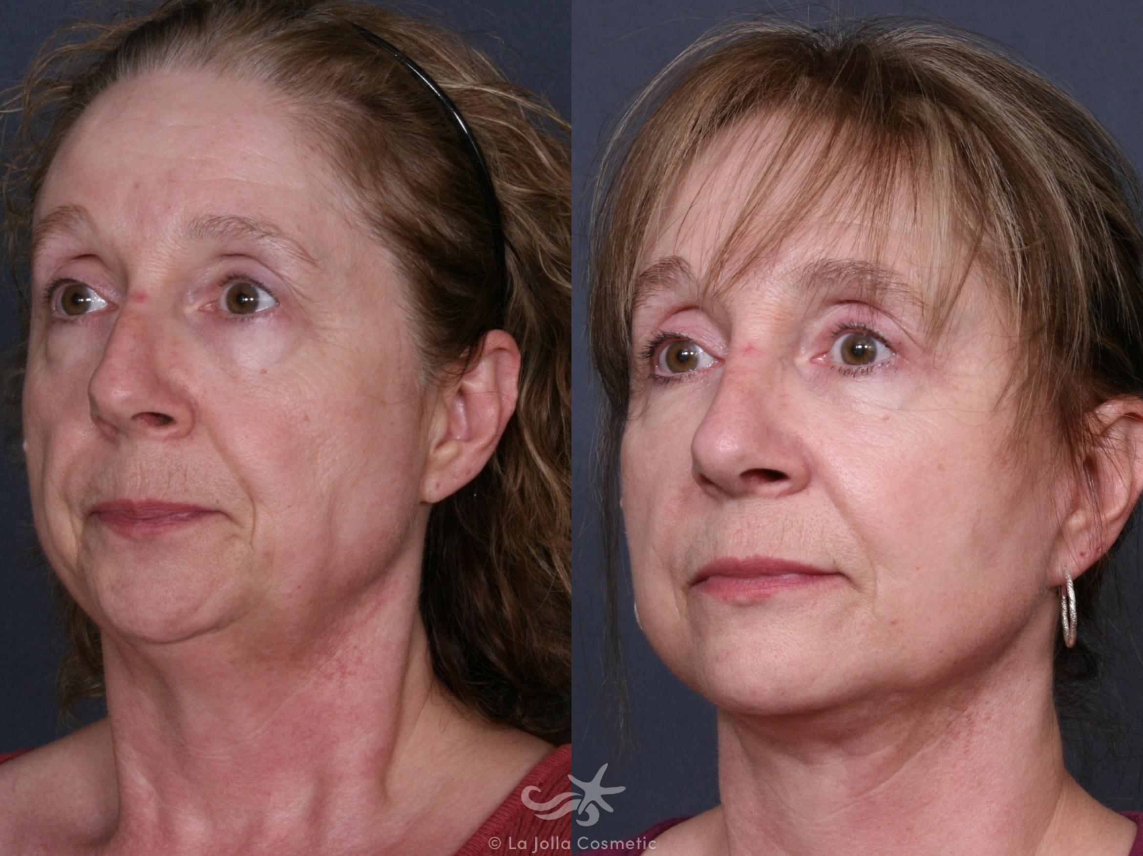 Before & After Facelift Result 284 Left Oblique View in San Diego, CA