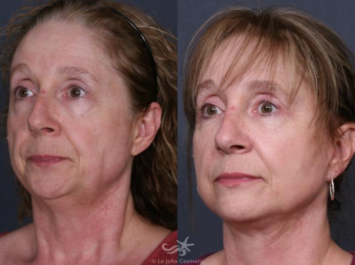Before & After Facelift Result 284 Left Oblique View in San Diego, Carlsbad, CA