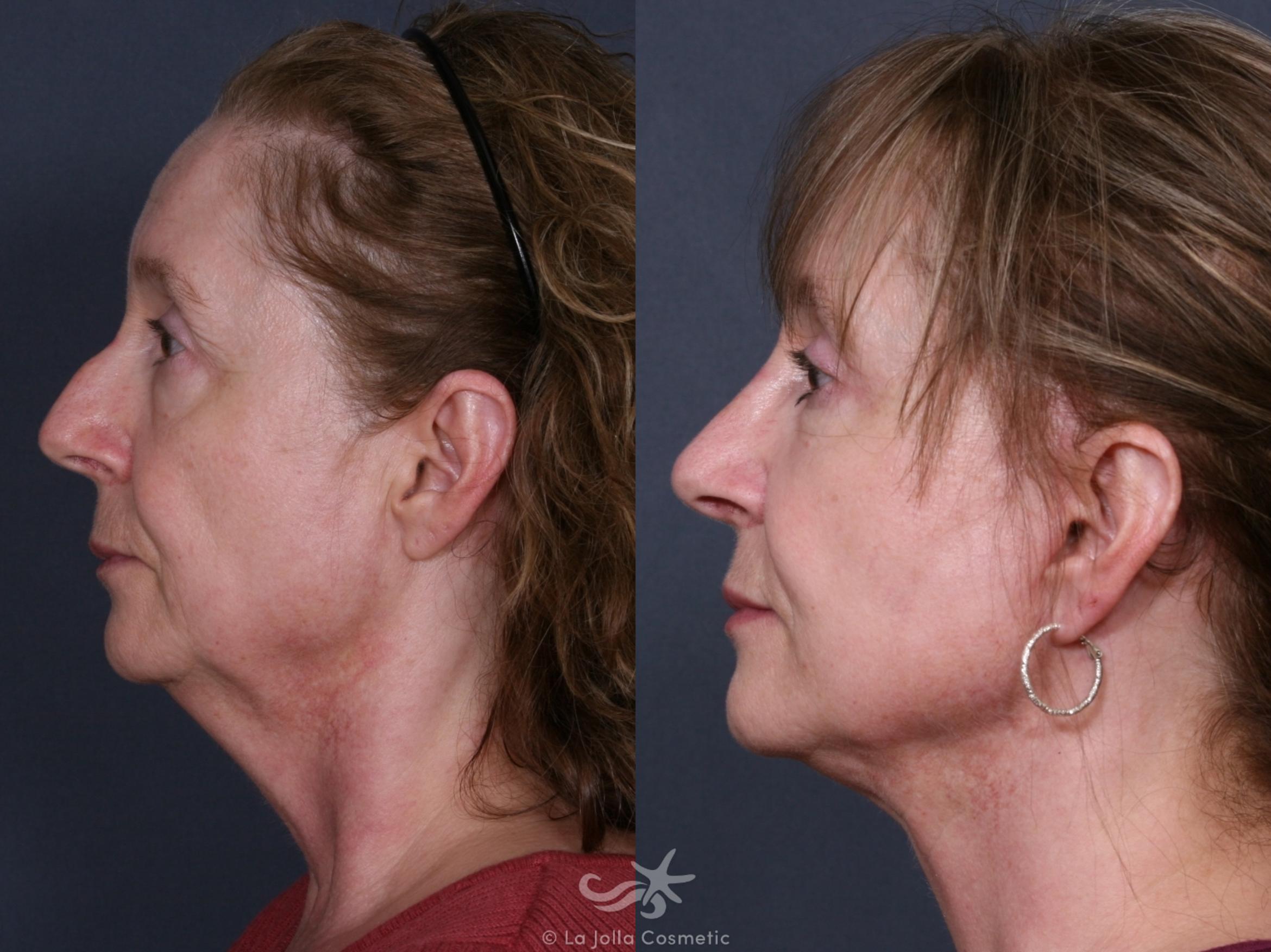 Before & After Facelift Result 284 Left Side View in San Diego, CA