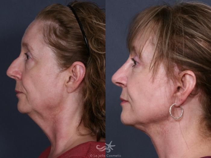 Before & After Facelift Result 284 Left Side View in San Diego, Carlsbad, CA