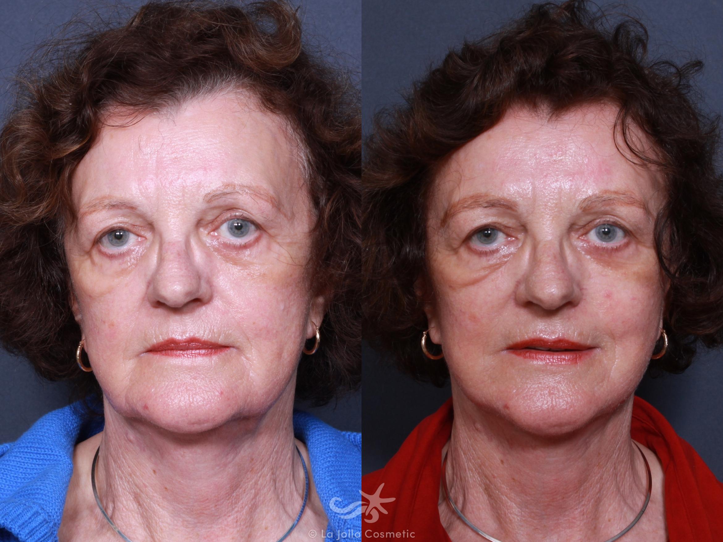 Before & After Facelift Result 320 Front View in San Diego, CA