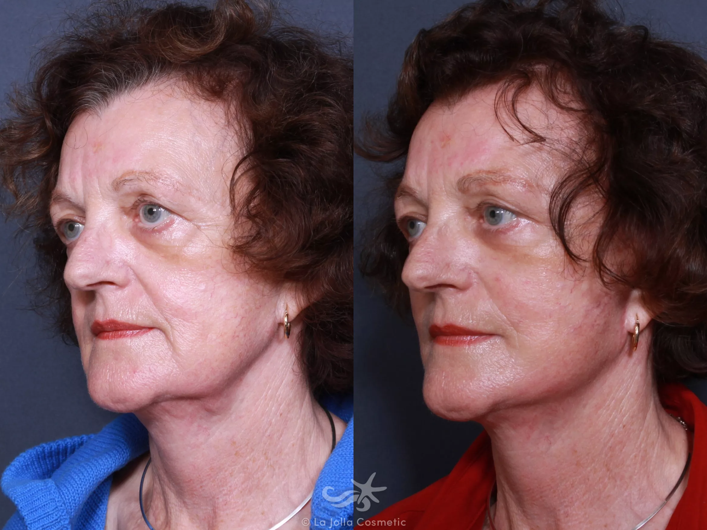 Before & After Facelift Result 320 Left Oblique View in San Diego, CA