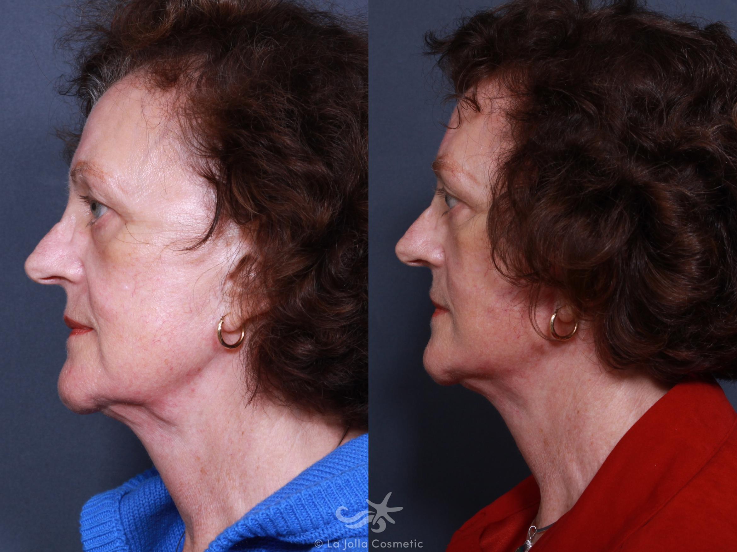 Before & After Facelift Result 320 Left Side View in San Diego, CA