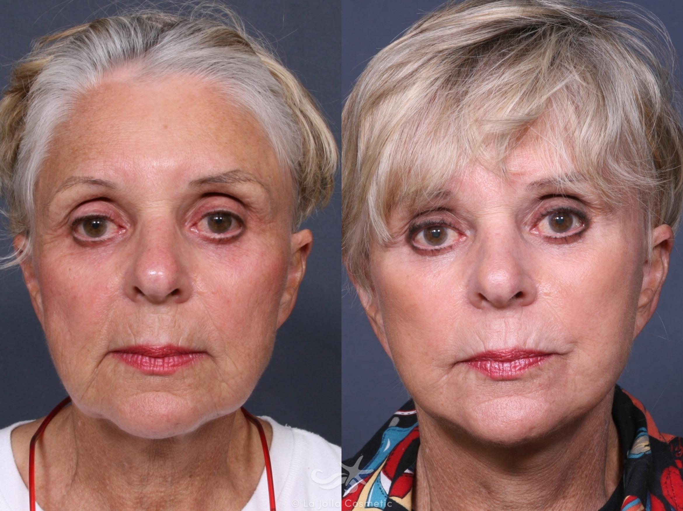 Before & After Facelift Result 324 Front View in San Diego, CA